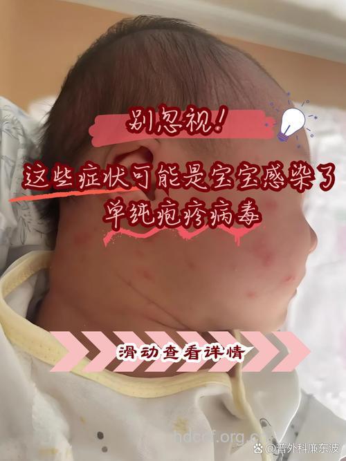 婴儿老是病毒感染