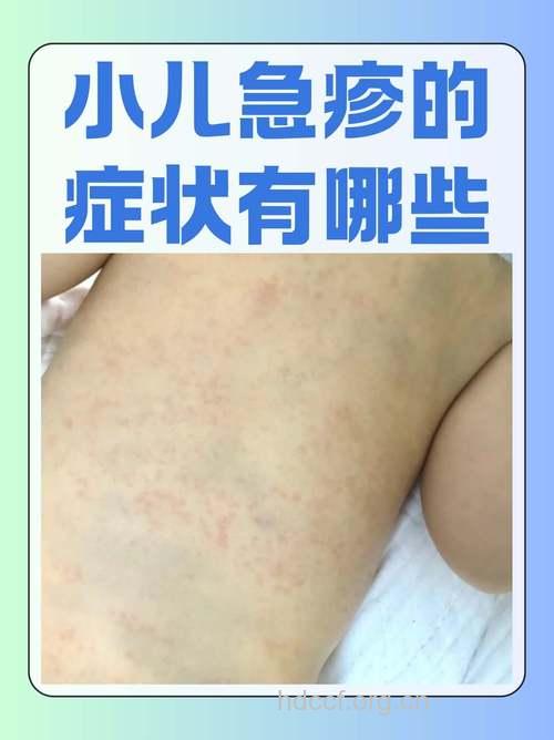 婴儿玫瑰疹