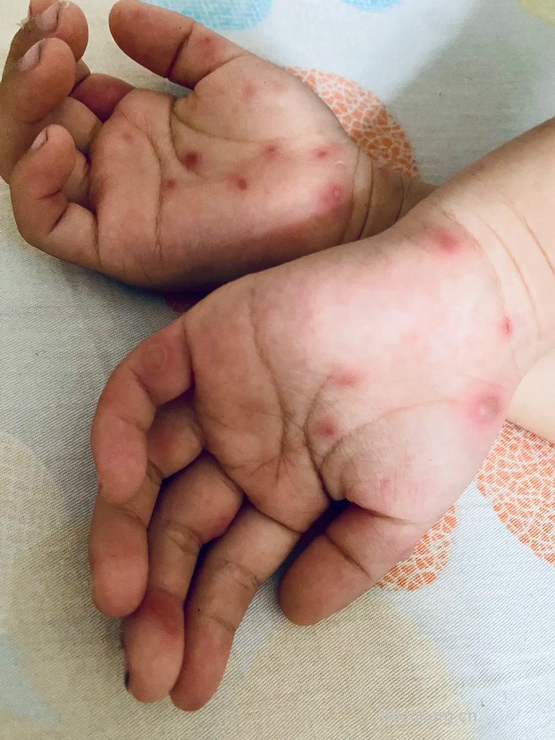 小儿手足口病症状