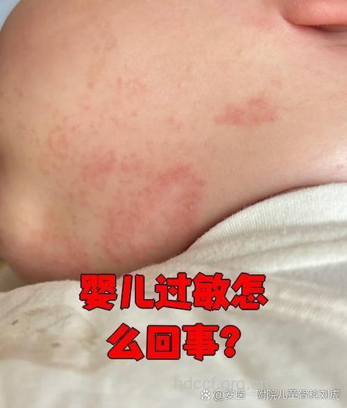 婴儿过敏