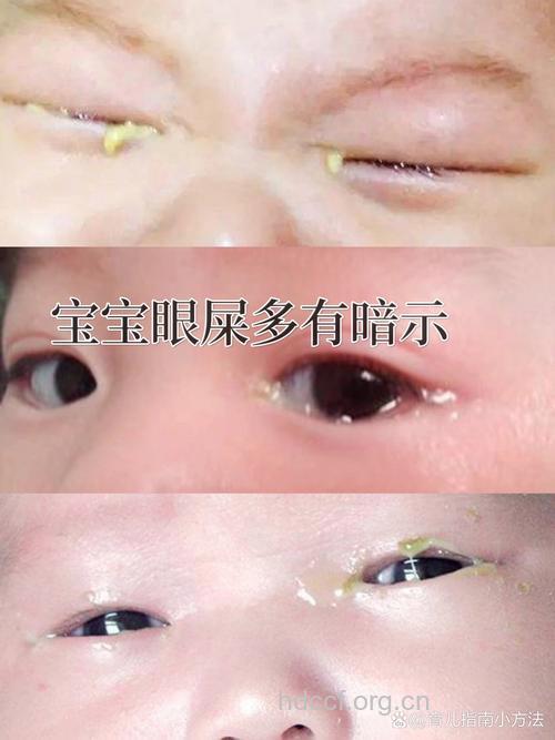宝宝眼屎多