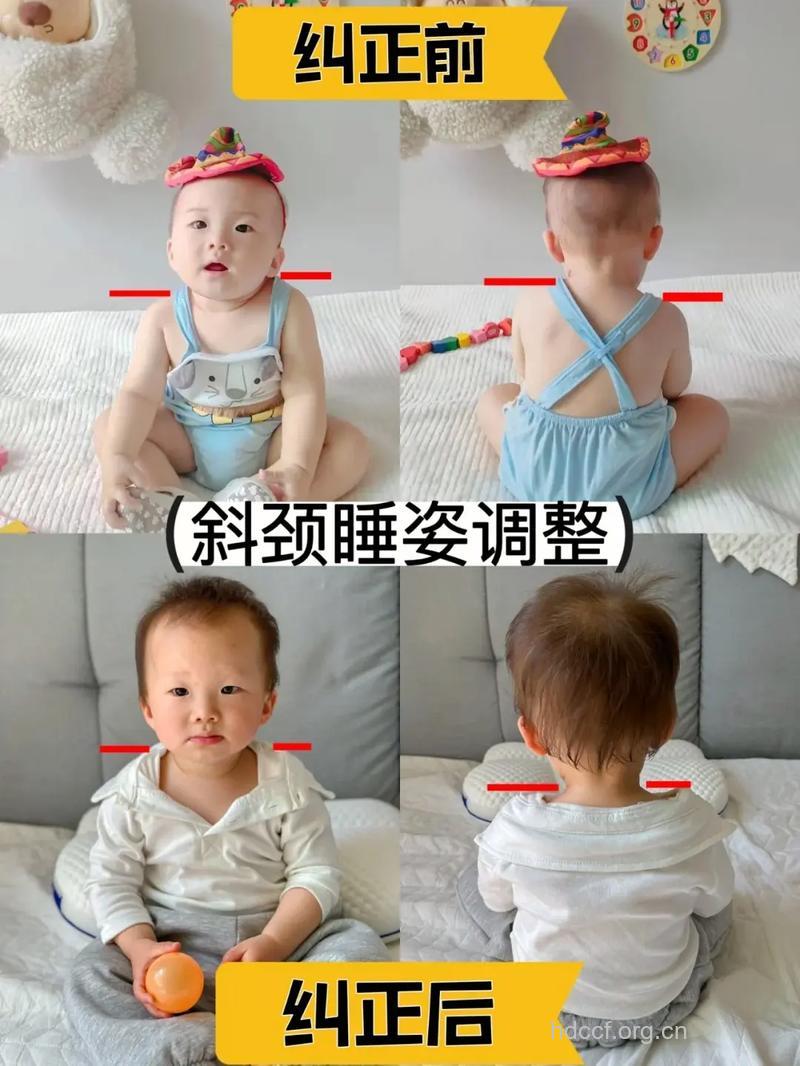 婴儿斜颈