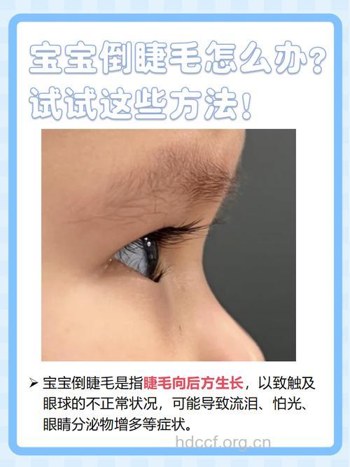 宝宝倒睫