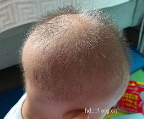 宝宝头发稀少