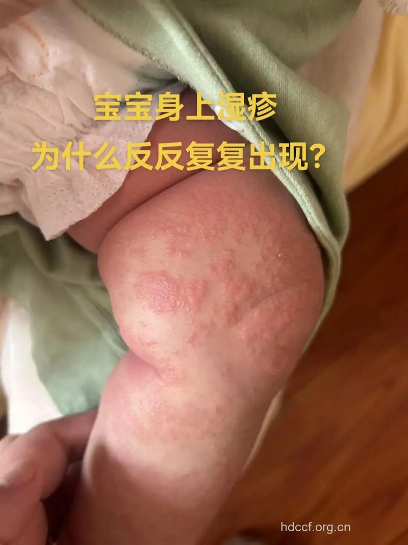 小儿过敏性湿疹