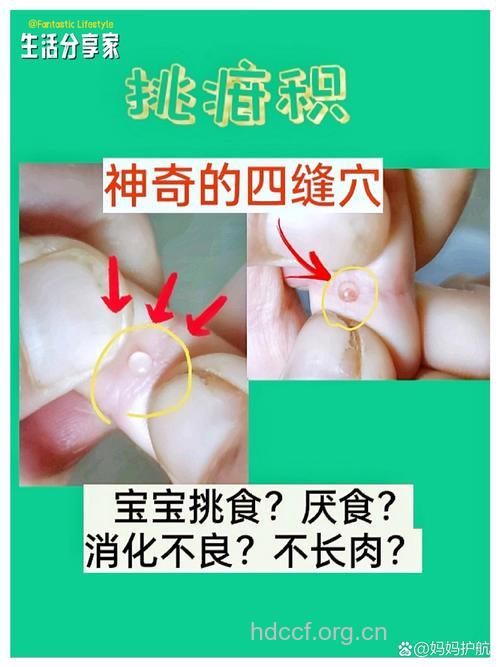 小儿疳积