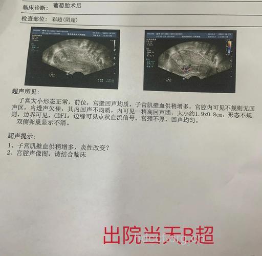 葡萄胎是怎么回事 葡萄胎怎么确诊