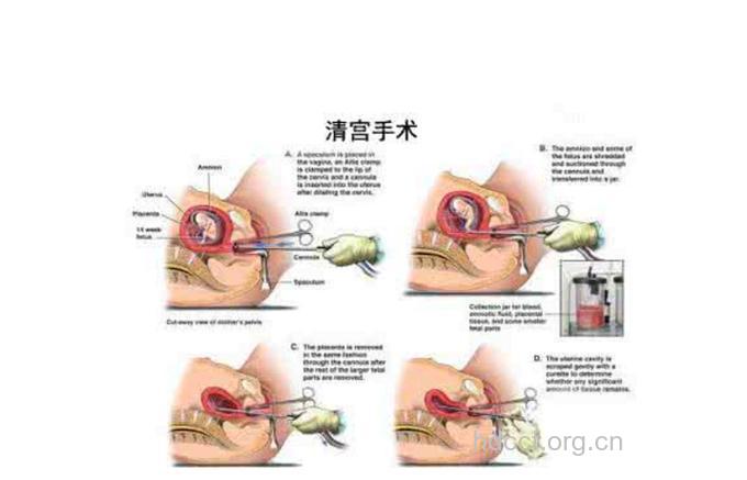 葡萄胎怎么进行清宫手术