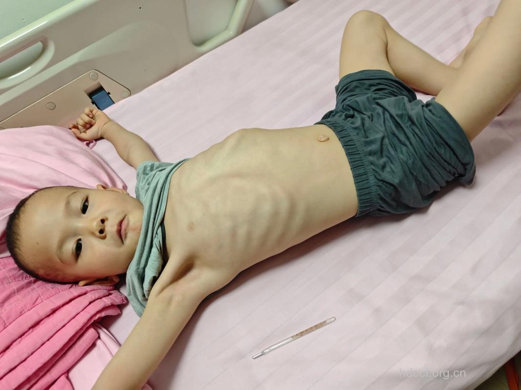 幼儿营养不良