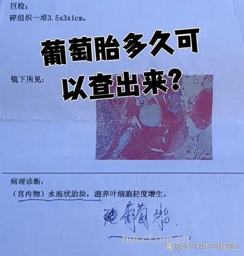 葡萄胎有哪些检查手段