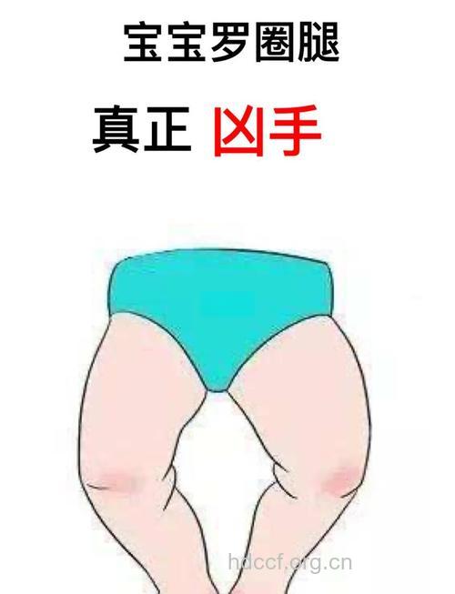婴儿罗圈腿