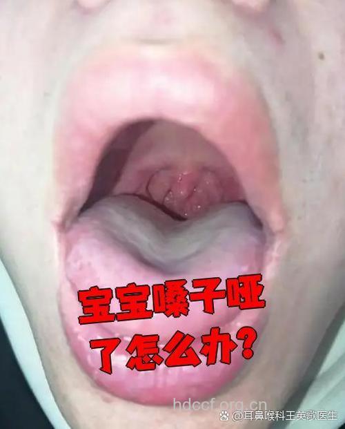 小孩嗓子哑