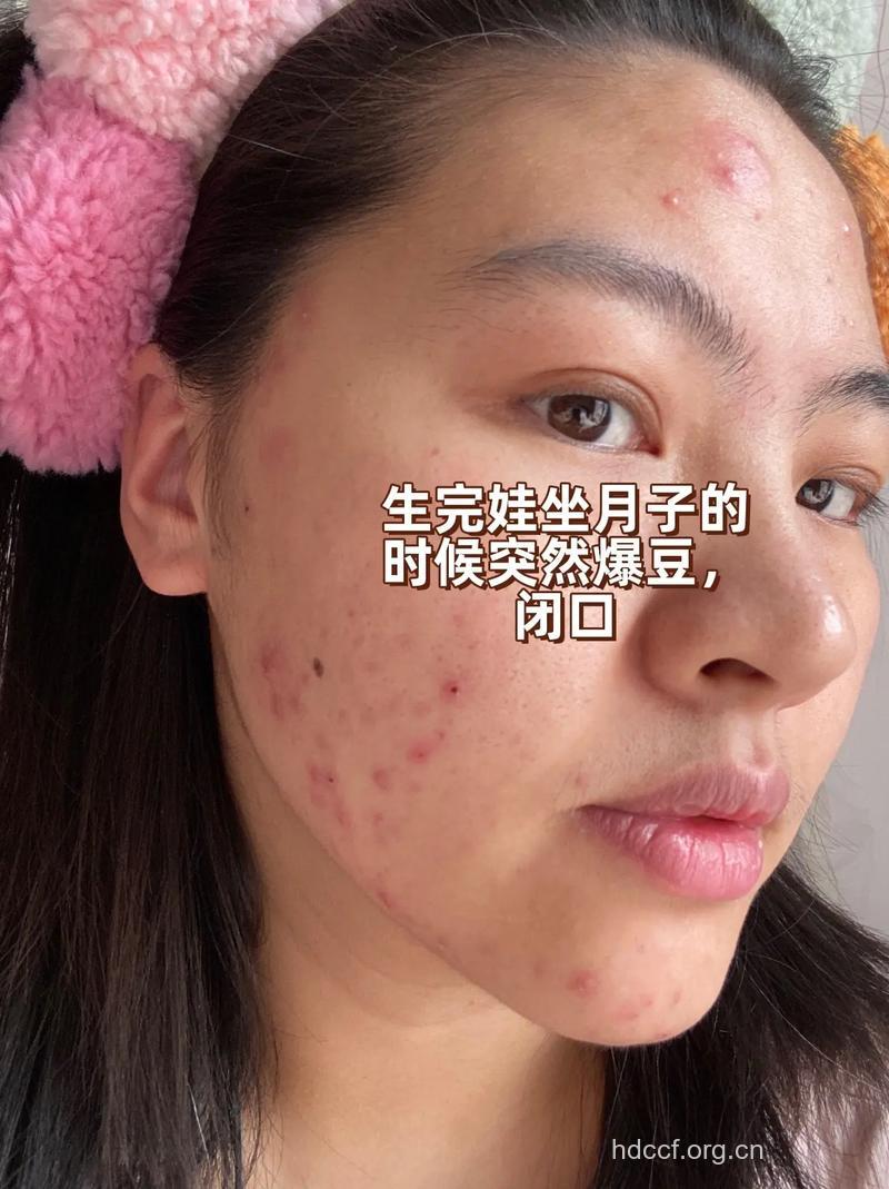 产后长痘 产后皮肤过敏怎么办
