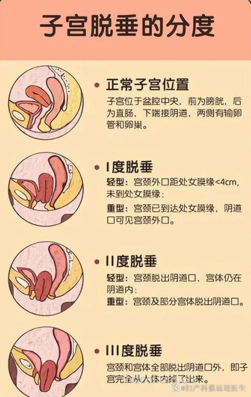 产后子宫下垂的症状有哪些