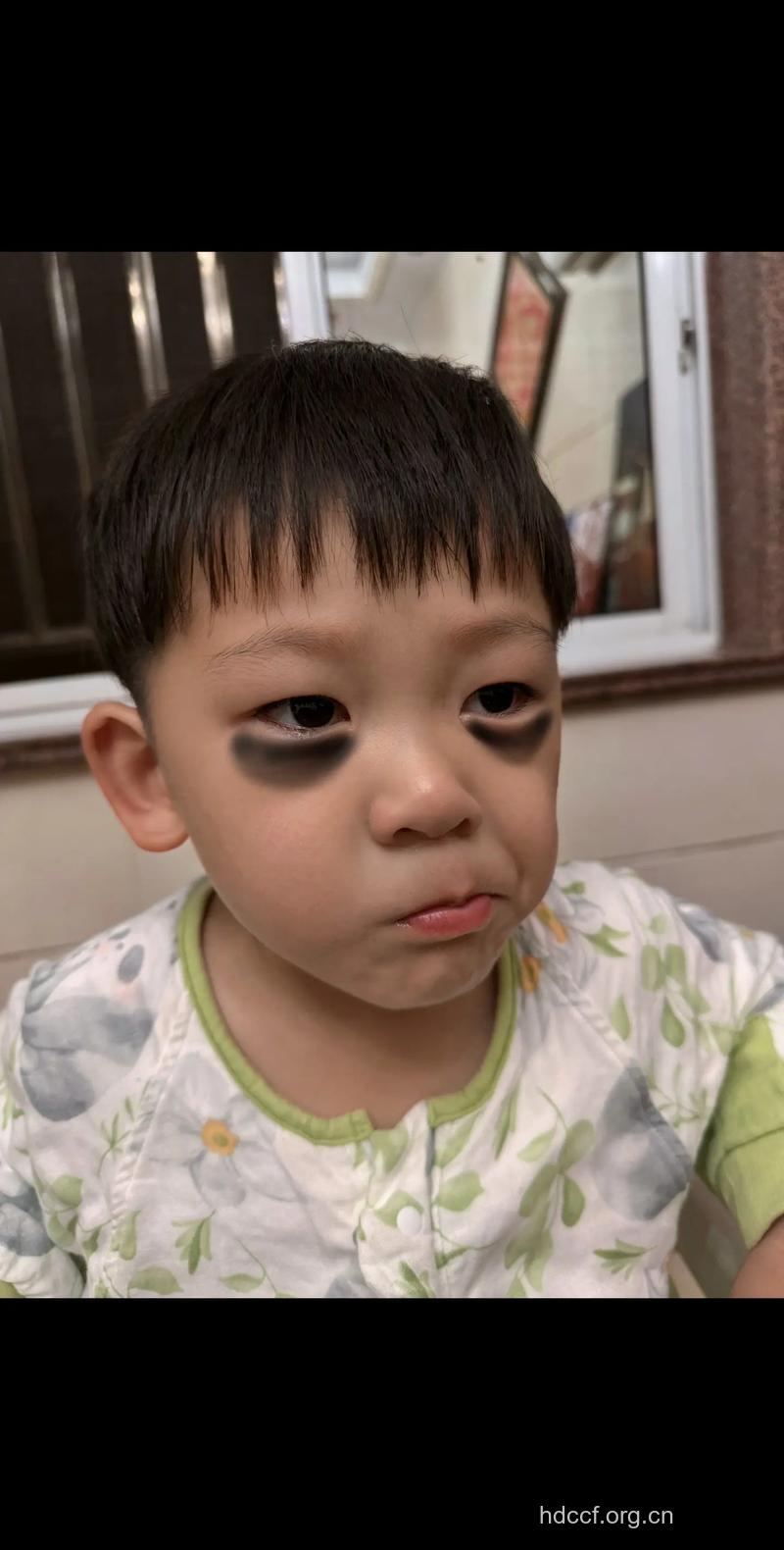 小孩黑眼圈