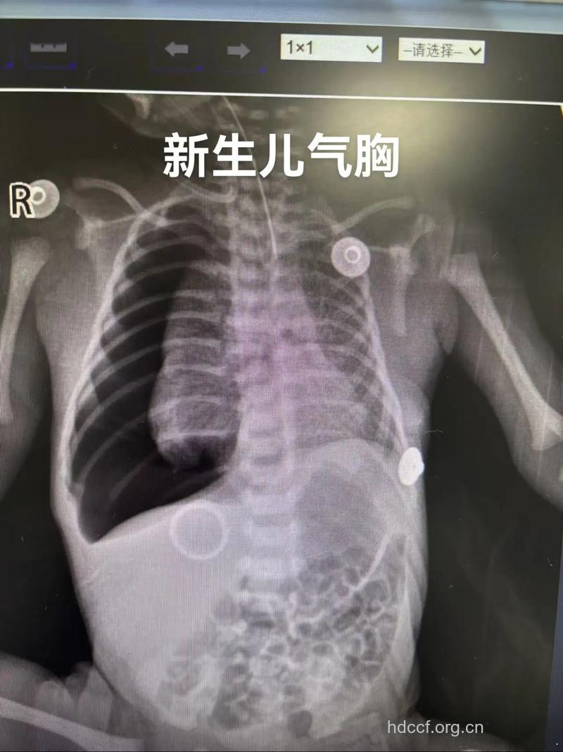 小儿气胸