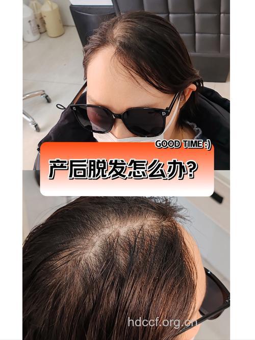 提神美发常梳头 赶走产后脱发小烦恼