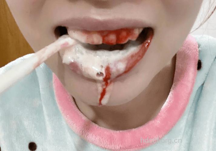 孩子刷牙出血