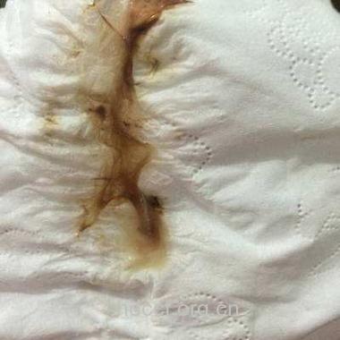 产后出现了褐色分泌物是怎么回事