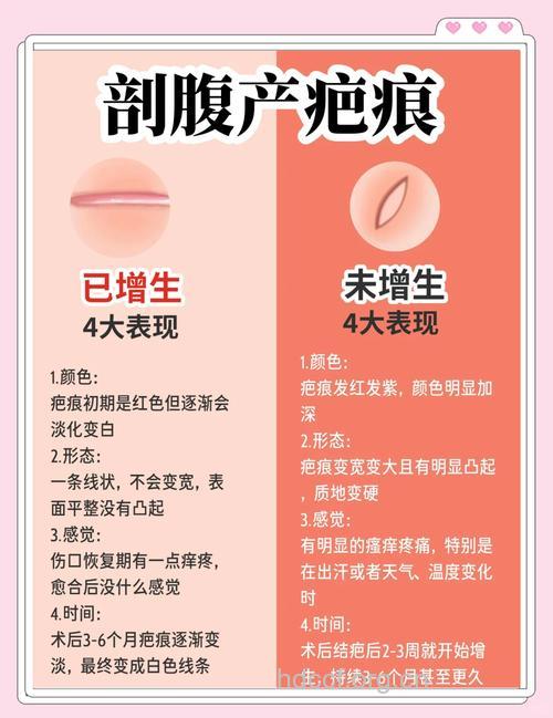 剖腹产疤痕增生怎么办 女性要掌握这些要点