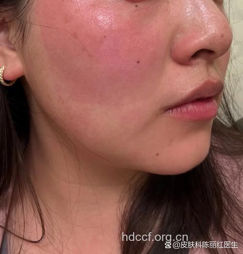 午后潮热的症状表现 满脸通红心跳快