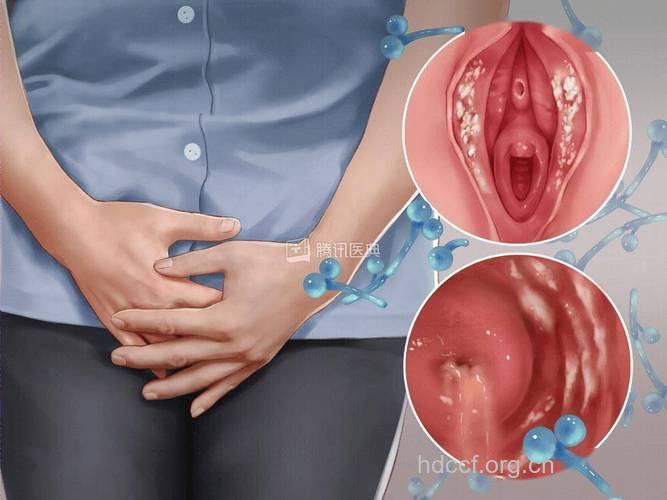 手淫未必是外阴阴道炎的罪魁祸首