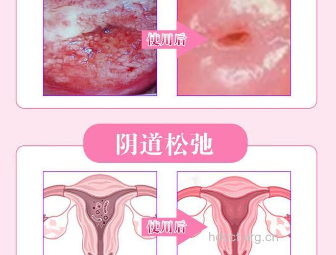阴道炎与宫颈糜烂有什么区别