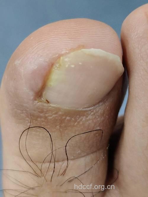 反复阴道炎竟因灰指甲