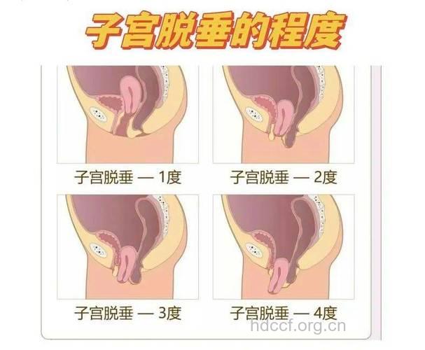 阴道难炎之隐体征特点