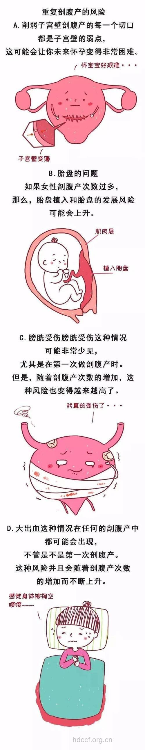 女性一生最多可做几次剖腹产