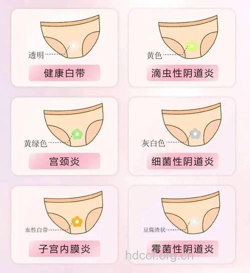 滴虫性阴道炎的早期症状 请认真看帮助预防