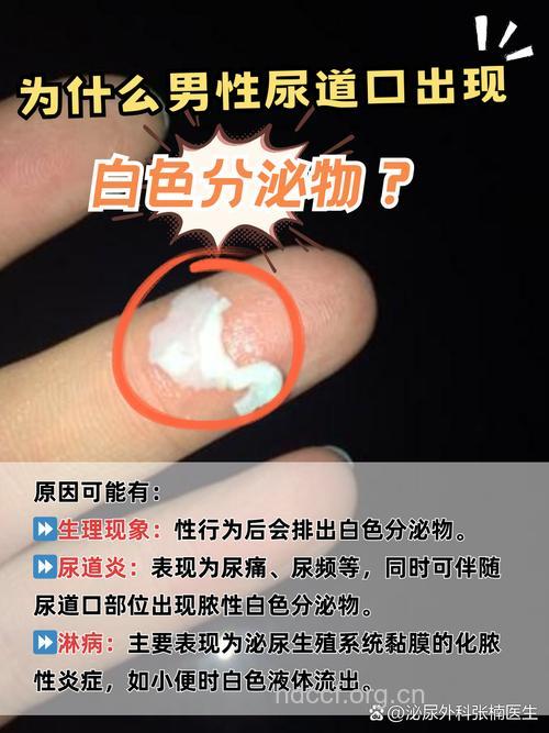 私处出水是漏尿吗 要警惕水样白带