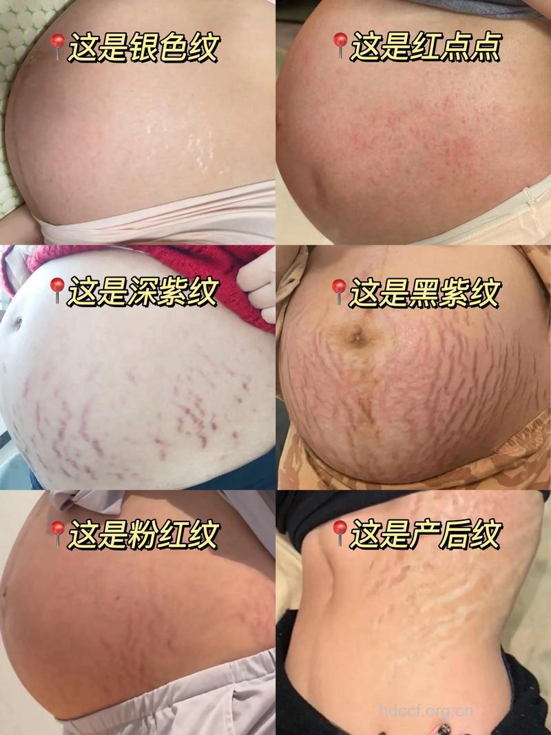 女性不想长妊娠纹 怀孕期间请做好这些事