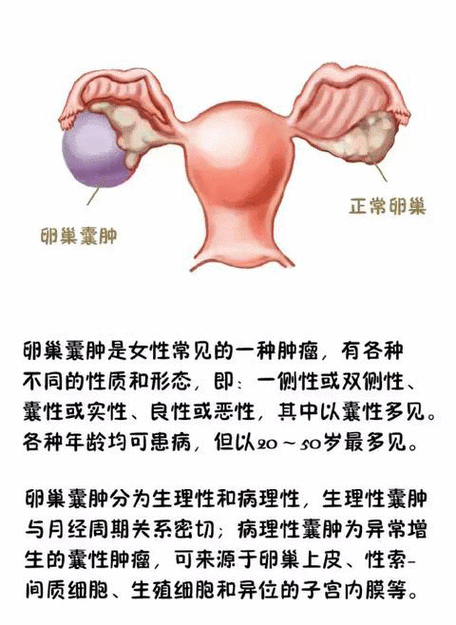 卵巢囊肿的治疗方法你知道多少