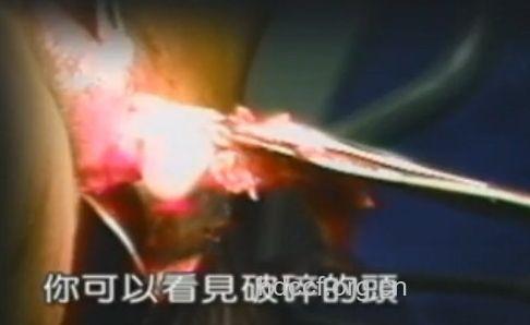 人工流产手术的全过程