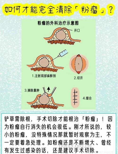 手术治疗良性卵巢囊肿的方法