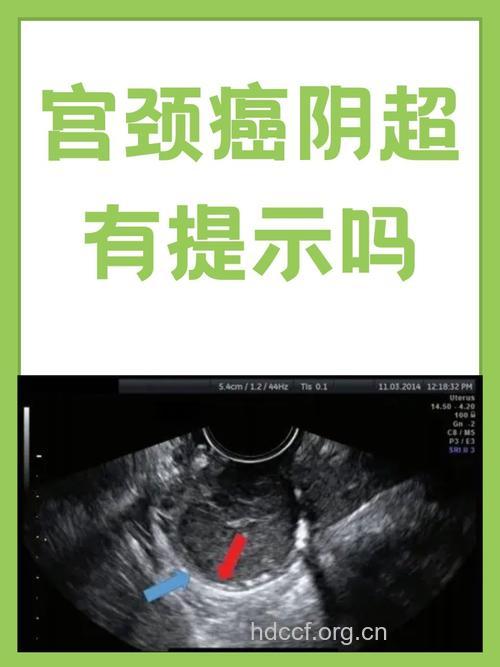 为什么贫困妇女患宫颈癌几率大