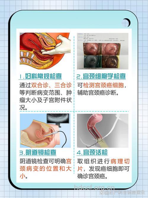 宫颈癌的定期检查很重要