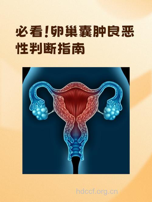 卵巢囊肿是否会恶变