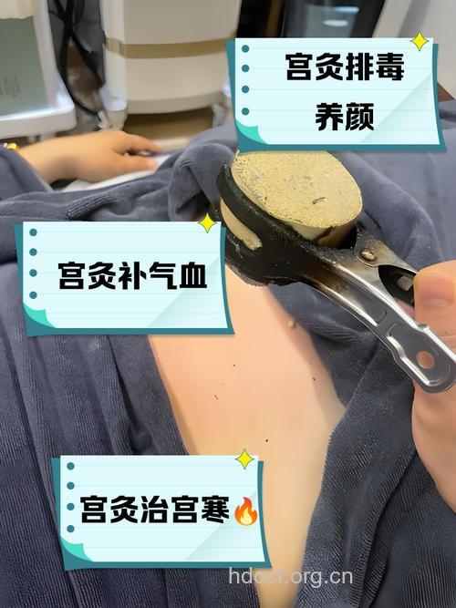 摆脱女性困扰 艾灸食疗治疗带下病