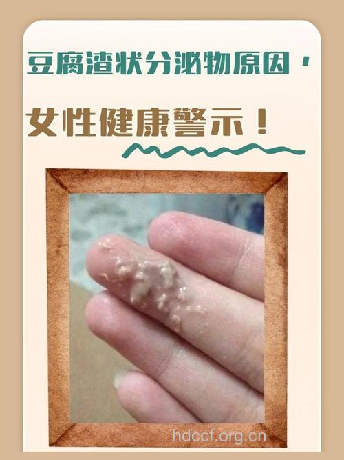 女性白带豆腐渣状是怎么引起的