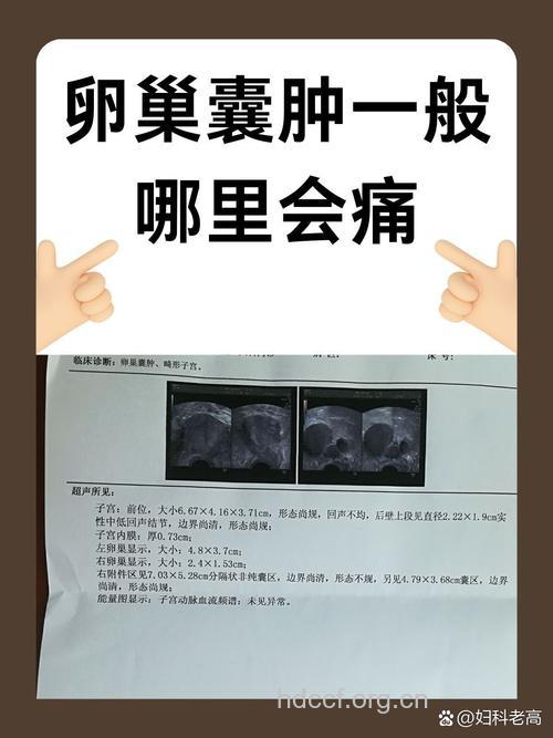 恶性卵巢囊肿的严重性