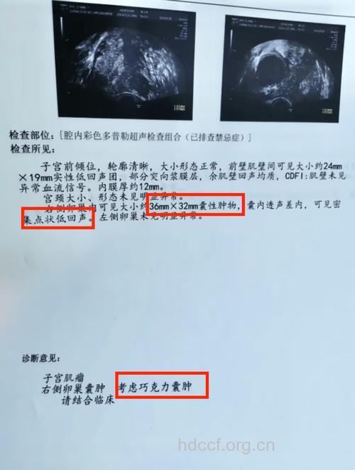 “巧囊”致不孕或早衰