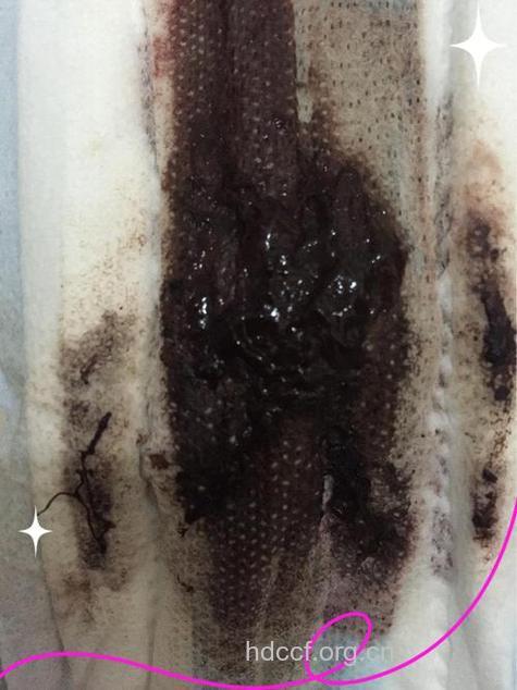 例假期间血是黑色的 是怎么回事