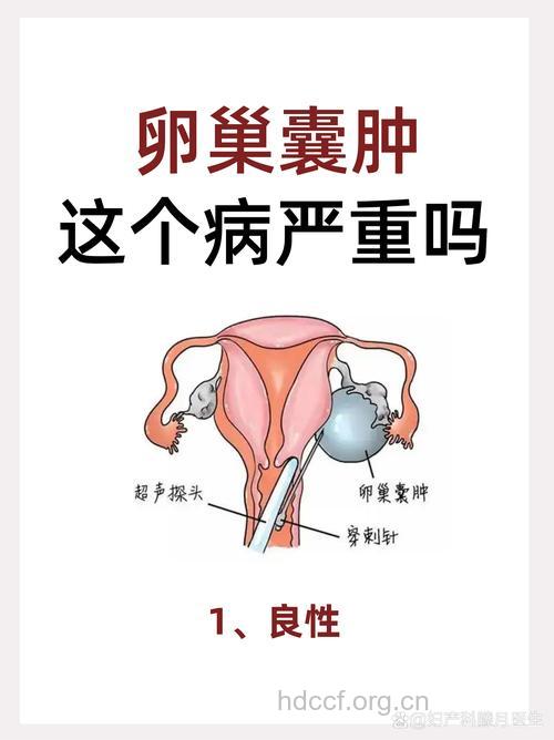 不同种类的卵巢囊肿的严重性
