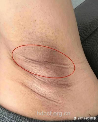 刮腋毛是否会导致乳腺癌