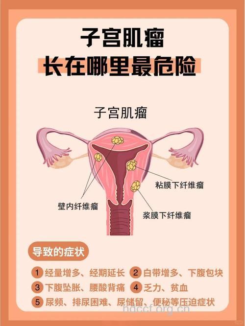 子宫肌瘤存在什么危害