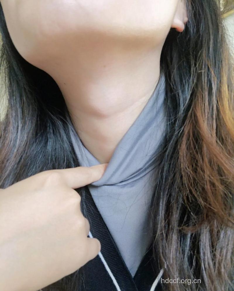 女生有喉结 或是甲状腺增大