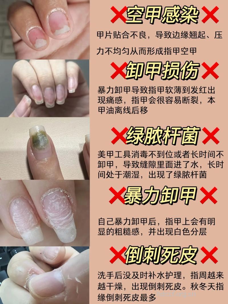 女人常做美甲要提防这4种病