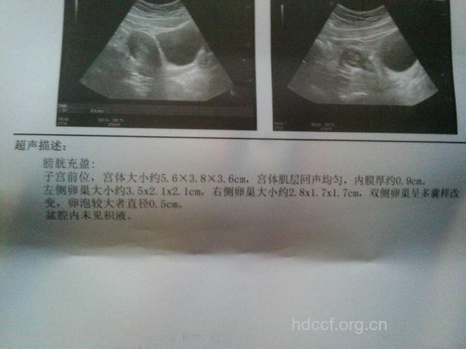 多囊卵巢综合症b超能检查出来吗